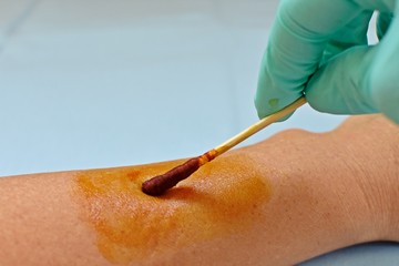 Doctor hand applying iodine on a white arm scar. Medical concept.