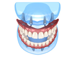 Maxillary and Mandibular prosthesis with gum All on 4 system supported by implants. Medically accurate 3D illustration of human teeth and dentures