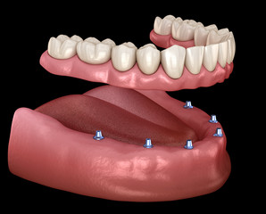 Mandibular prosthesis with gum All on 6 system supported by implants.  Medically accurate 3D illustration of human teeth and dentures concept