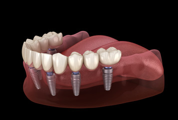 Mandibular prosthesis All on 6 system supported by implants. Medically accurate 3D illustration of human teeth and dentures concept