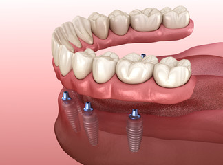 Mandibular prosthesis with gum All on 6 system supported by implants.  Medically accurate 3D illustration of human teeth and dentures concept