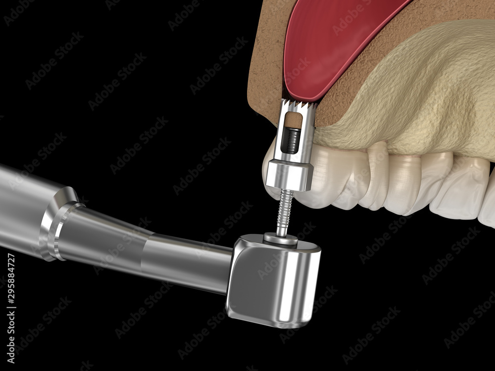 Wall mural sinus lift surgery - creating an access to the sinus. 3d illustration