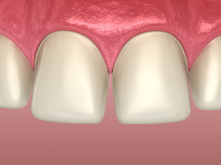 Teeth preparation for Veneer installation procedure over central incisor and lateral incisor. Medically accurate tooth 3D illustration