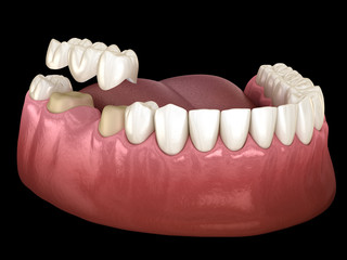 Dental bridge of 3 teeth over molar and premolar. Medically accurate 3D illustration of human teeth treatment