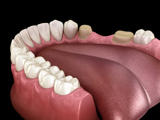 Preparated molar and premolar tooth for dental bridge placement. Medically accurate 3D illustration