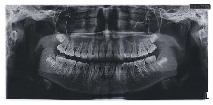 Dental x-ray for teeth surgery with the rudiments of wisdom teeth