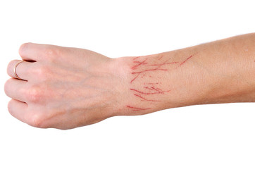 Scratches on the hand of a cat. Adult man.