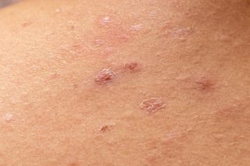 scars on the skin of a female body left by acne