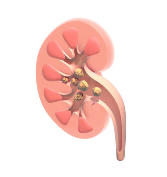 3D anatomical illustration of the kidney interior showing large kidney stones, realistic image.