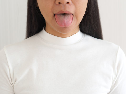 white tongue in asian woman caused by debris, bacteria and dead cells getting lodged on isolated white background use for health care concept.