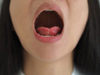 ankyloglossia in asian woman and cause of an unusually short of tissue tethers the bottom of the...