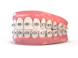 Fake Teeth Set With Braces