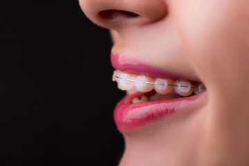 Obraz premium Braces. Beautiful Woman healthy smile close up. Closeup Ceramic Braces on Teeth. Beautiful Female Smile with Braces. Orthodontic Treatment.