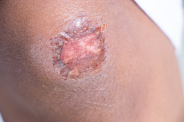 Closeup injured at leg, Fresh wounds from accident. 