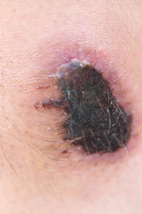 Closeup injured at leg, Fresh wounds from accident. 