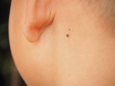 black mole on neck child boy near ear of skin lesion case of proliferation of pigment derma cells and melanocytic pigmented naevus.