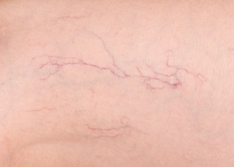 A fragment of human skin with varicose veins. Varicose veins closeup. Varicose veins disease.