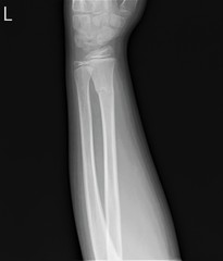 radiograph of the left forearm with a fracture of the radius