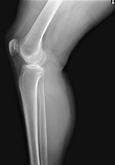 normal x-ray of the knee joint