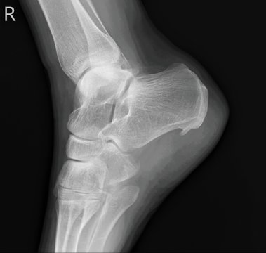 heel spur on the x-ray of the right heel bone