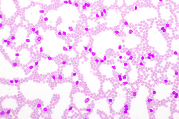 Picture of leukemia cells in blood smear, analyze by microscope, 400x