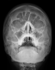 normal radiography of the paranasal sinuses of the facial skull