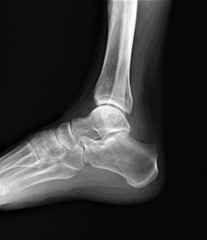 normal radiograph of the ankle joint