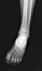 normal radiograph of the ankle joint