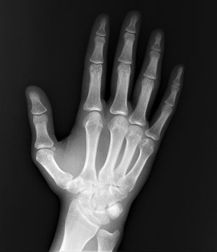 normal x-ray of the hand bones