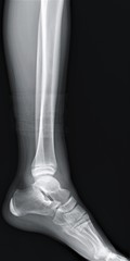 normal radiograph of the ankle joint