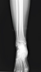 normal radiograph of the ankle joint