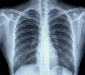 lung chest x-ray images
