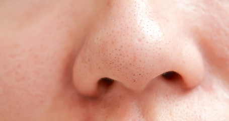 blackheads on woman nose