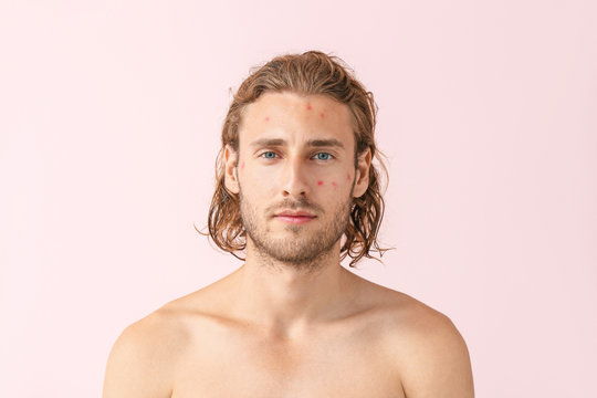Portrait of young man with acne problem on color background