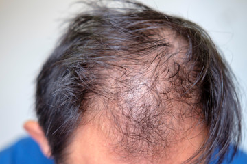 Fototapeta premium young man of baldness and health and medicine concept