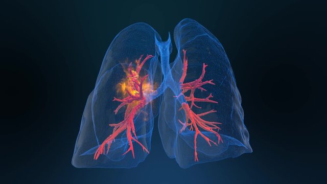 3d rendered illustration of lung cancer 3D illustration
