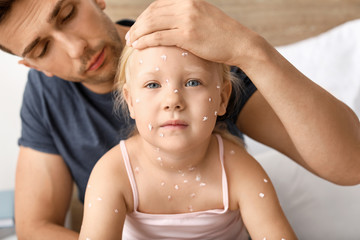 Man taking care of his little daughter ill with chickenpox at home