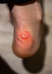 water blister on heel of the feet caused long walking in new inconvenient uncomfortable shoes