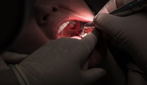 treatment of tooth caries, dental  close-up.