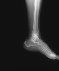 normal radiograph of the ankle joint