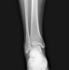 normal radiograph of the ankle joint