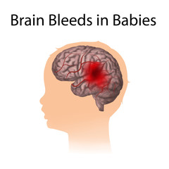 Brain bleeds in babies. Hemorrhage. Blood, head. Medical illustration.
