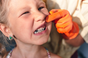 The doctor is trying to see the mouth of a little girl with an orthodontic appliance and crooked...