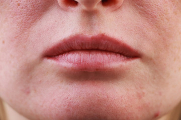 Obraz premium Expanded pores, acne, comedones, black spots. Lips close up. Problem skin girl