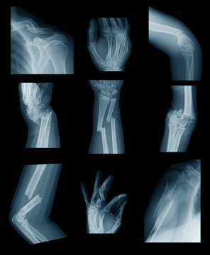 Collection X-ray image showing upper limb or uper extremity fractures