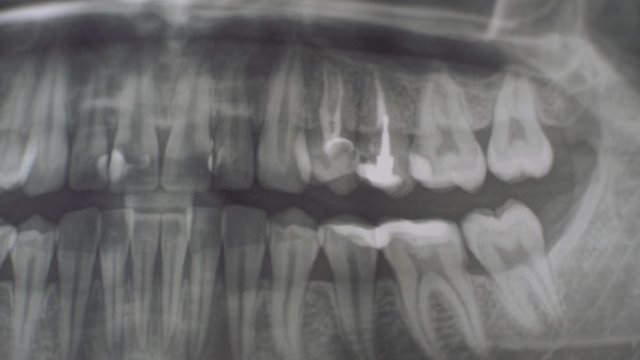 Dental clinic. X-ray printed on sheet. control quality of filling.