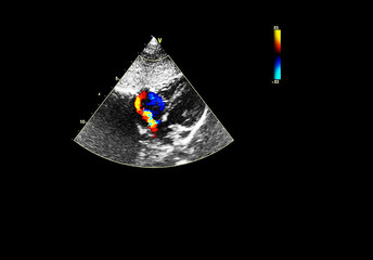 Screen of echocardiography (ultrasound) machine.