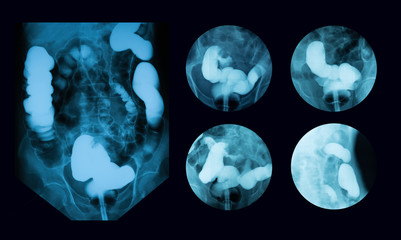 Lower gastrointestinal (GI) tract radiography (lower GI or barium enema), an x-ray examination of...
