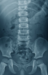Lumbosacral spine (LS spine) x-ray, anteroposterior (AP) view, a 2 year old asian boy patient