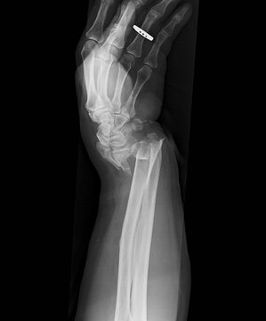 X-ray image of wrist jiont, lateral view, showing distal ulnar and radius fractures and dislocation